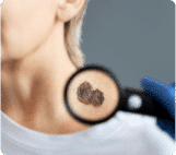 Um close do pescoço de uma pessoa com uma pinta grande e escura sendo examinada por uma lupa, destacando a importância da dermatologia